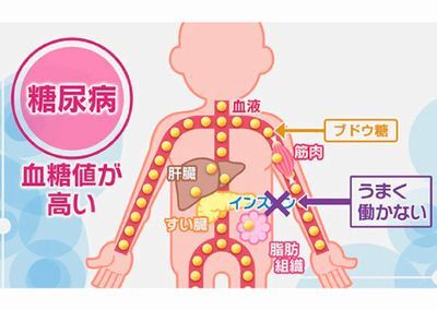 糖尿病の説明イラスト